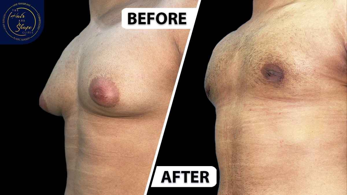 Gynecomastia result7